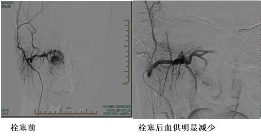 运动后流鼻血_流鼻血后剧烈运动_流鼻血后运动会造成什么后果